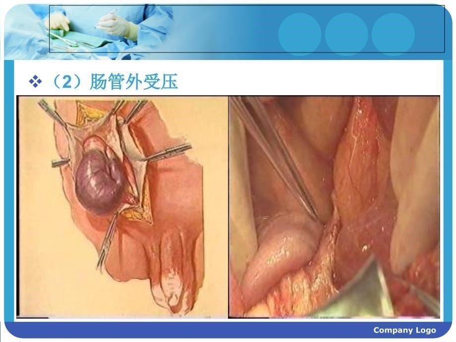 肠梗阻护理查房完整版本.ppt_第5页