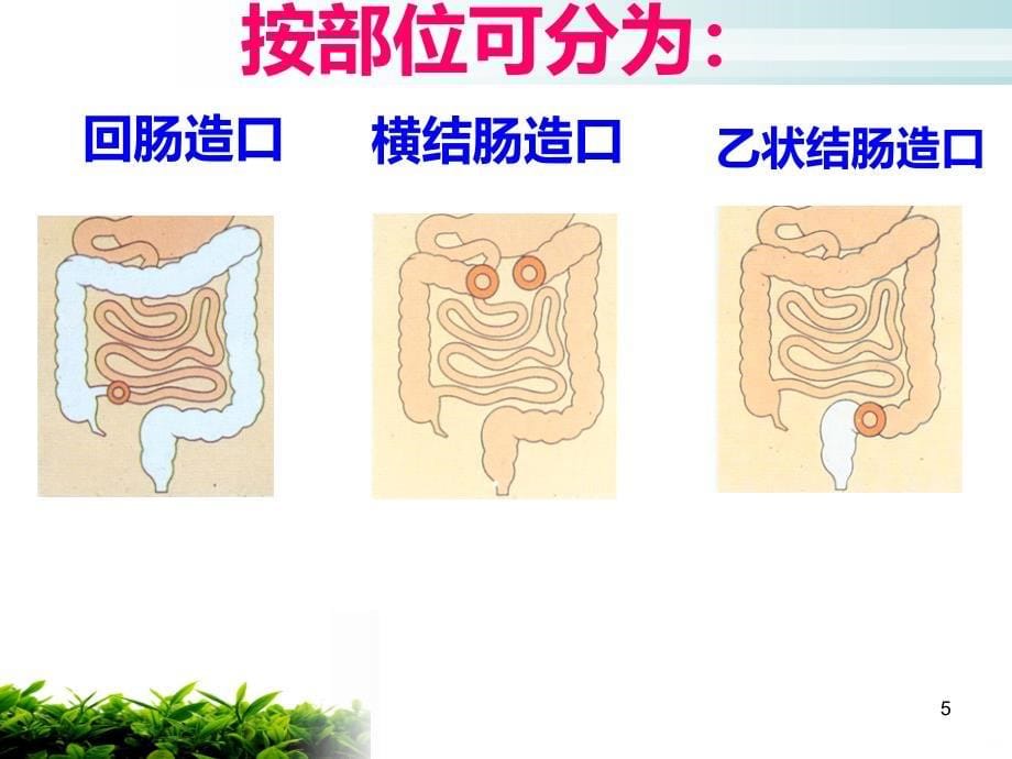 肠造口护理技巧PPT课件.ppt_第5页