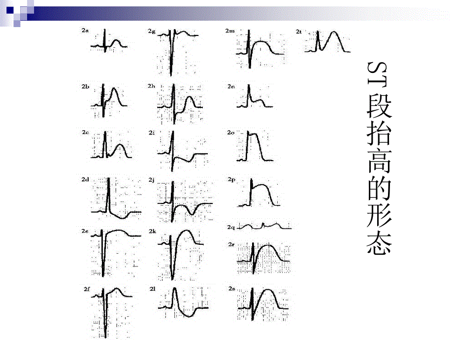 急性心肌梗死的心电图诊断完整版本.ppt_第4页