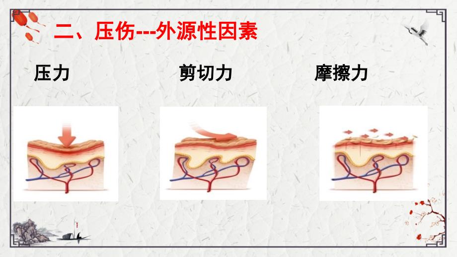 压伤的护理PPT课件.ppt_第4页