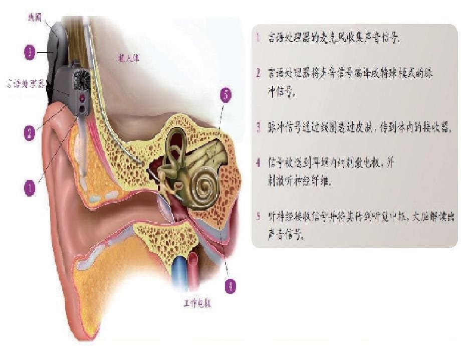 人工耳蜗技术简介和_护理55777PPT课件.ppt_第5页