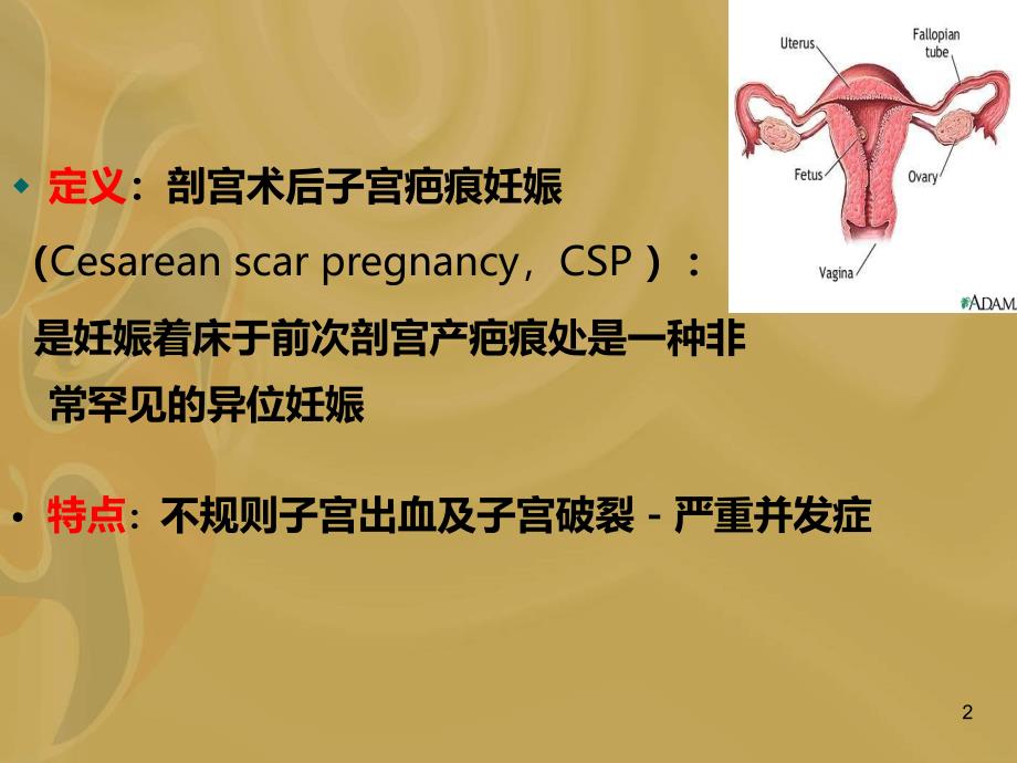 剖宫产术后瘢痕妊娠PPT课件.ppt_第2页