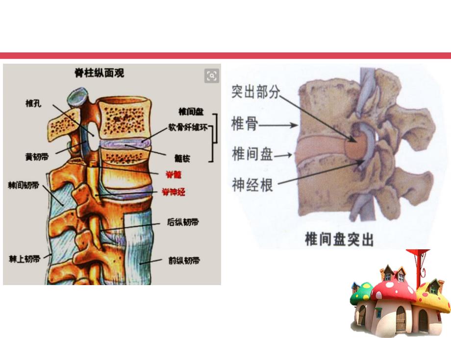 腰椎间盘突出症护理查房14327PPT课件.ppt_第4页