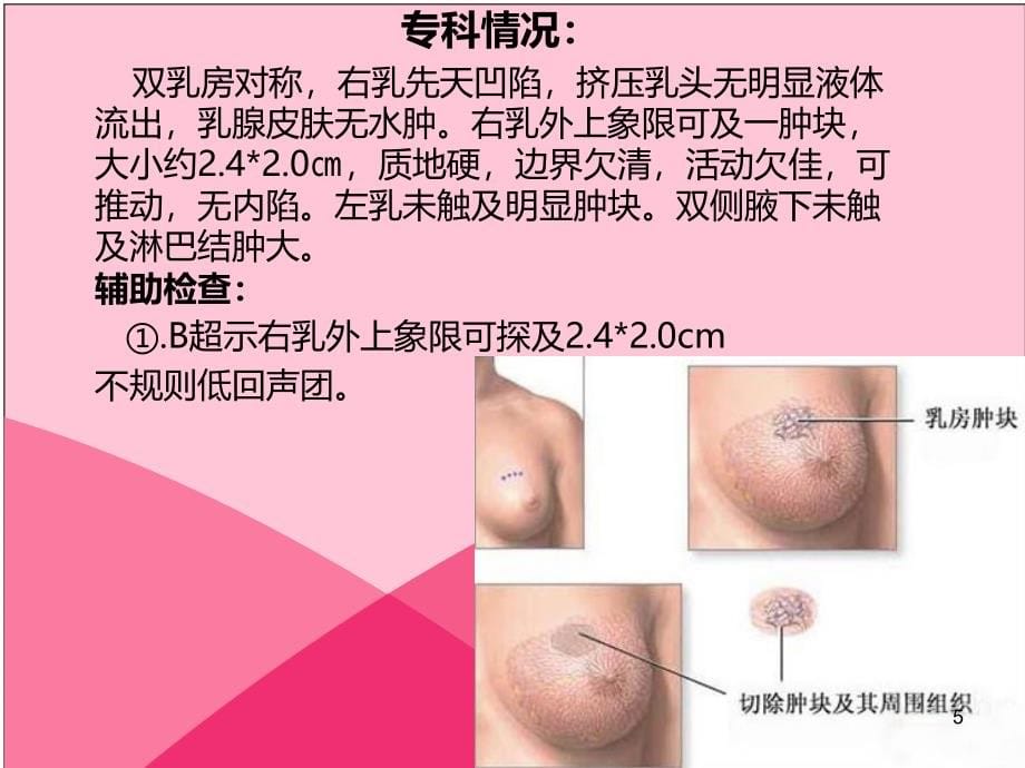 乳腺癌合并糖尿病护理PPT课件.ppt_第5页