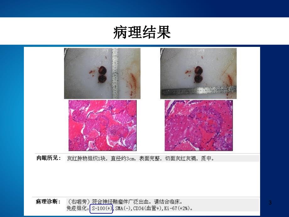 胃神经鞘瘤的诊断与鉴别诊断ppt课件.ppt_第3页