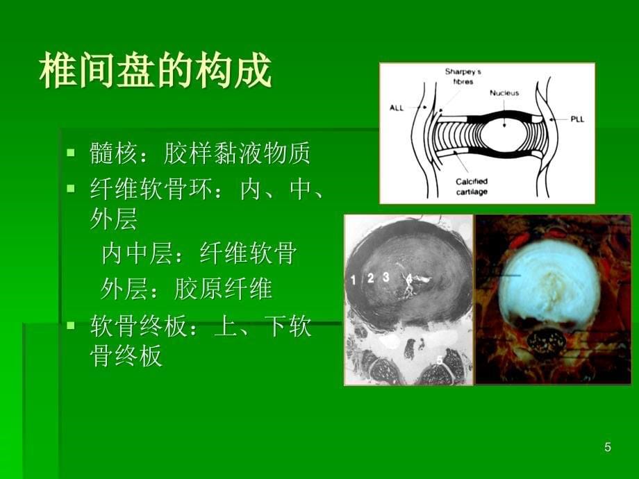 椎间盘突出的影像学诊断ppt课件.ppt_第5页