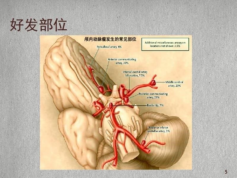 脑动脉瘤介入治疗及术后护理ppt课件.ppt_第5页