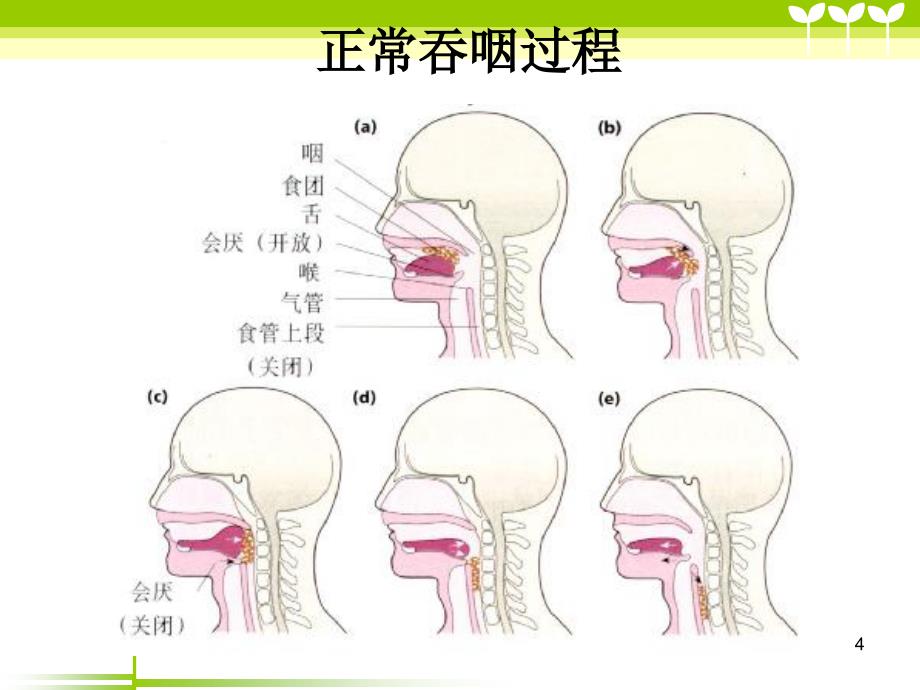 老年人吞咽障碍的评估及护理ppt课件.ppt_第4页