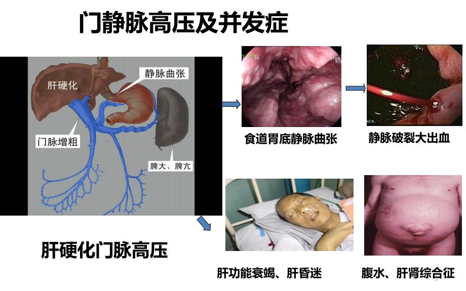 肝硬化治疗利器TIPS手术ppt课件.ppt_第3页