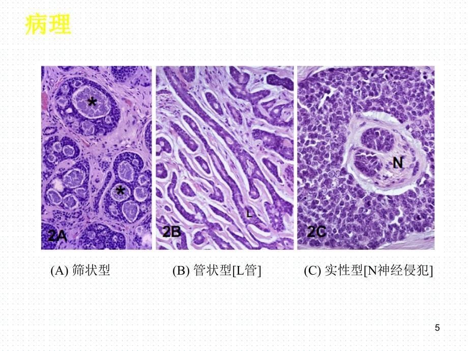 头颈部腺样囊性癌研究进展ppt课件.ppt_第5页