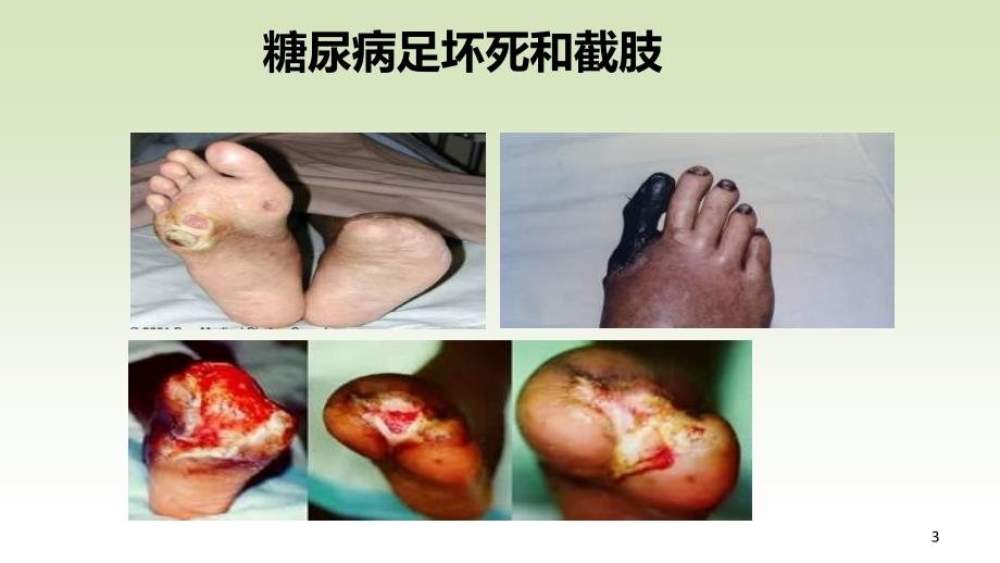 糖尿病健康教育糖尿病足ppt课件.ppt_第3页