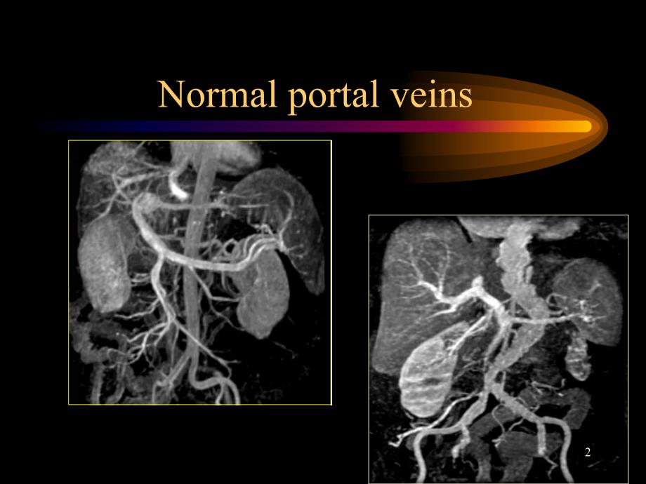 门静脉海绵样变ppt课件.ppt_第2页