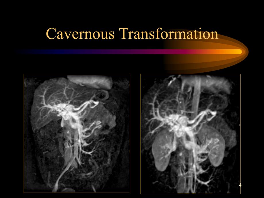 门静脉海绵样变ppt课件.ppt_第4页