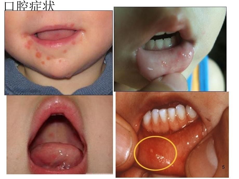 幼儿园健康教育手足口病的预防2ppt课件.ppt_第5页