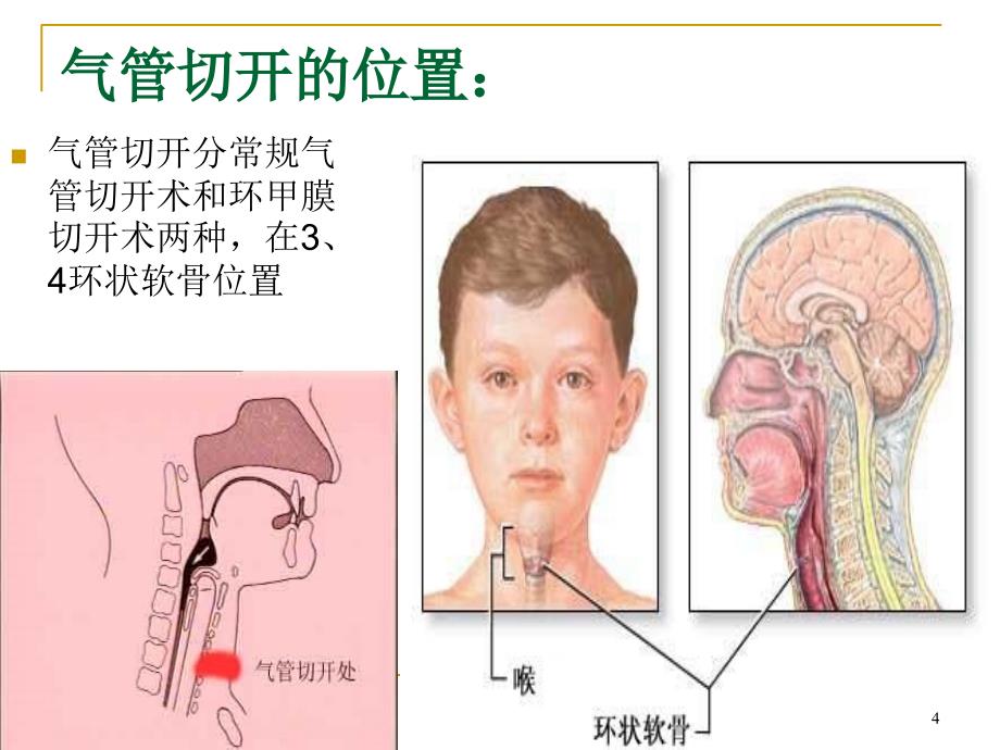 气管切开病人的护理2ppt课件.ppt_第4页