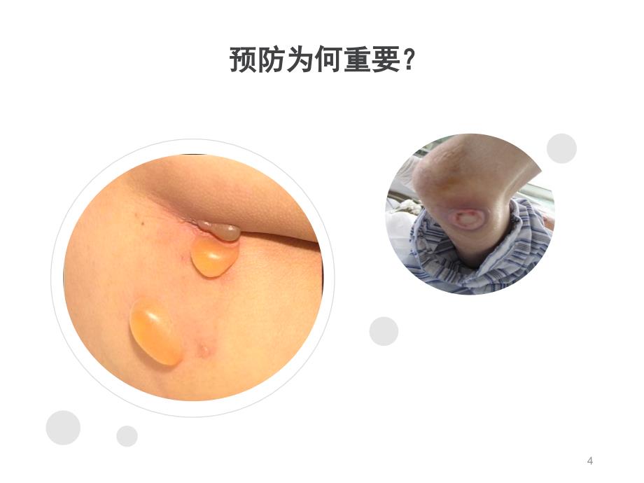 压疮的预防与处理ppt课件.ppt_第4页