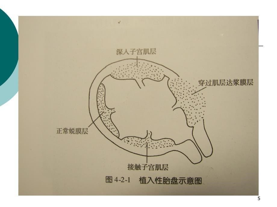 植入性胎盘ppt课件.ppt_第5页