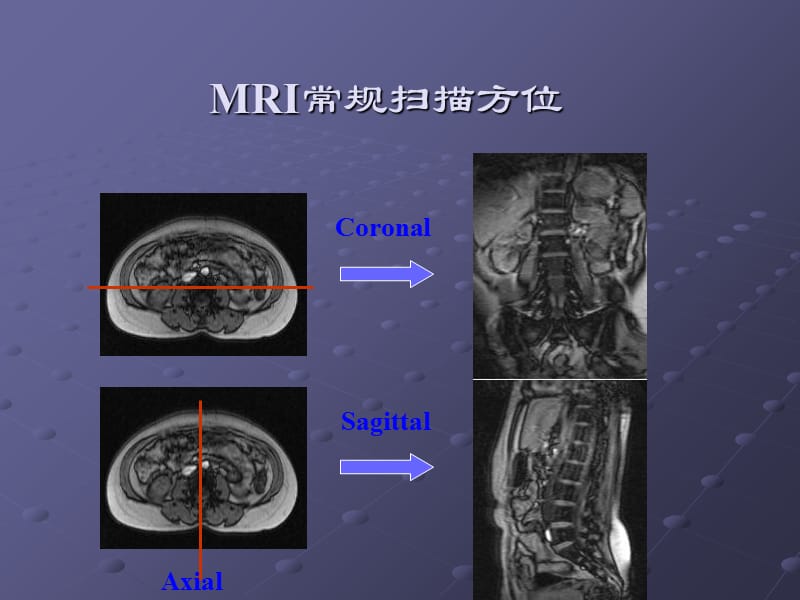 脊柱正常MRI表现及常见疾病ppt课件.ppt_第2页