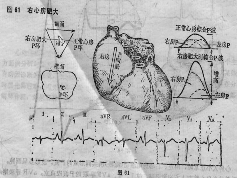 心电图房室肥大ppt课件.ppt_第5页