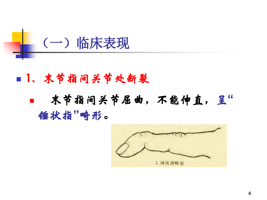 指伸屈肌腱断裂ppt课件.ppt_第4页