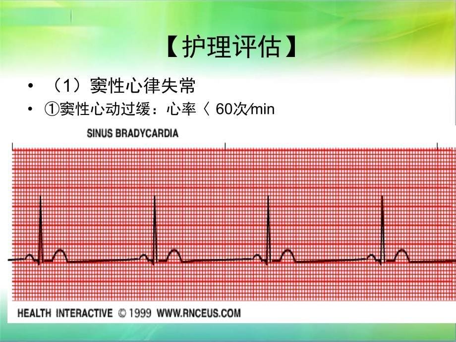 心律失常病人的护理查房ppt课件.ppt_第5页