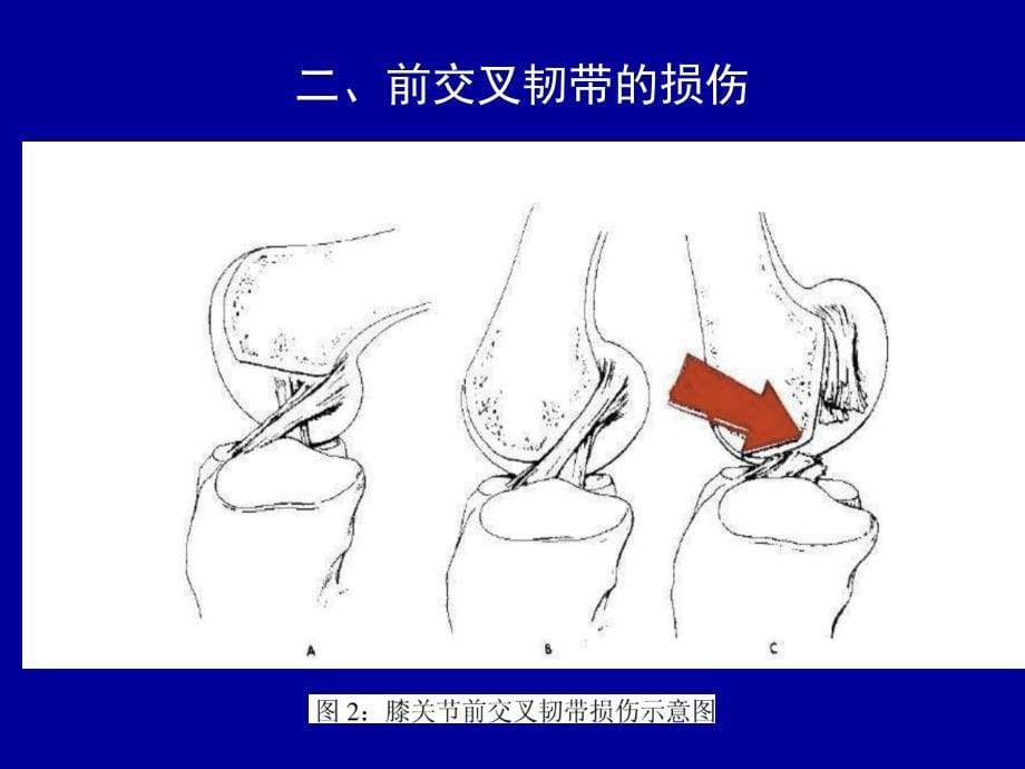 前交叉韧带重建术后康复41285ppt课件.ppt_第5页