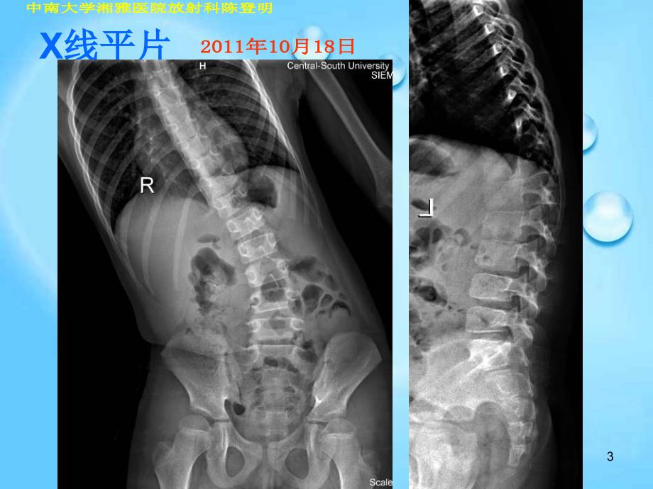 许莫氏结节典型影像ppt课件.ppt_第3页