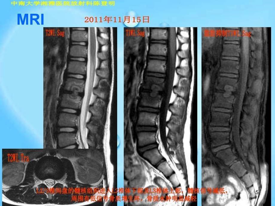 许莫氏结节典型影像ppt课件.ppt_第5页