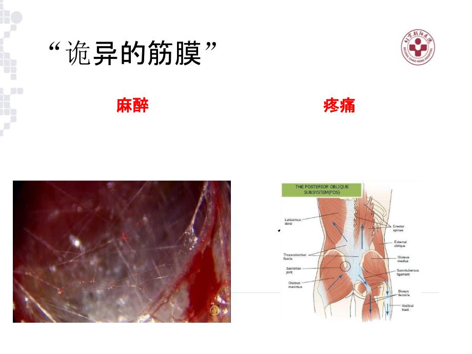 2017超声引导下竖脊肌阻滞在临床应用_第4页