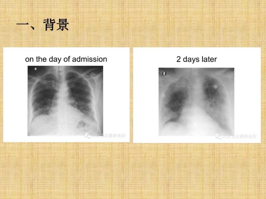 《中东呼吸综合征》PPT课件.ppt_第4页