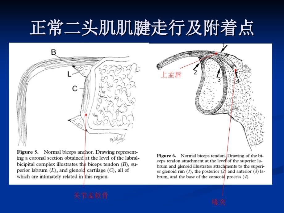 《肩关节MRI》PPT课件.ppt_第5页