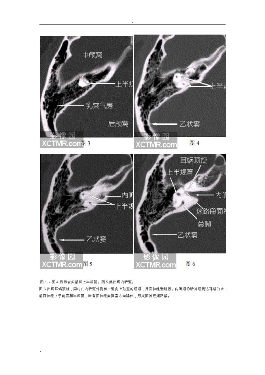 耳部CT解剖_第2页