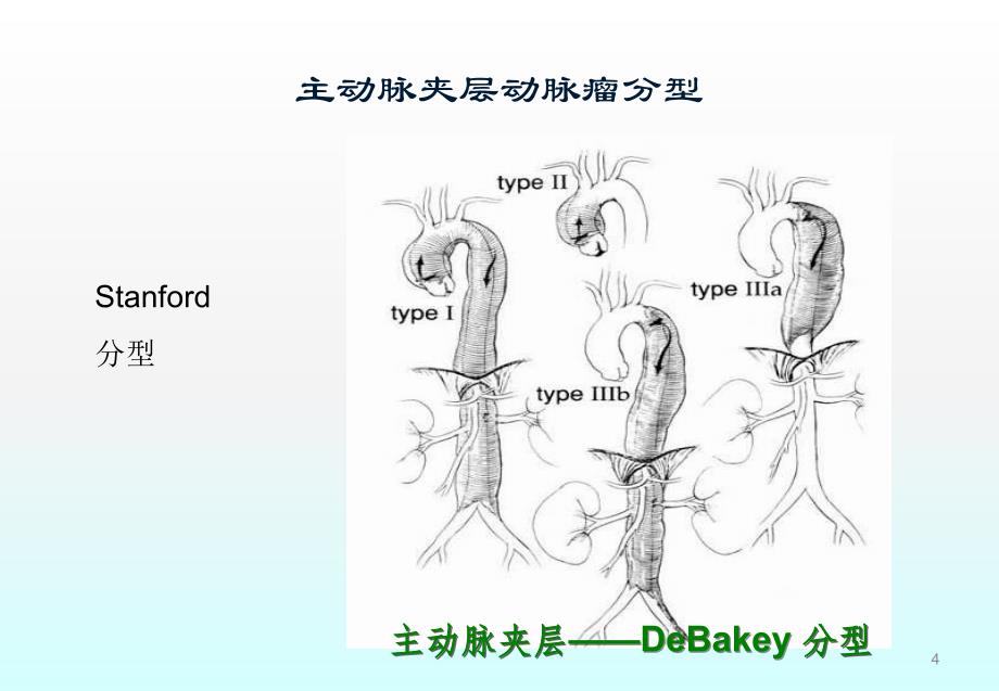 主动脉夹层动脉瘤诊断与治疗策略ppt课件.ppt_第4页