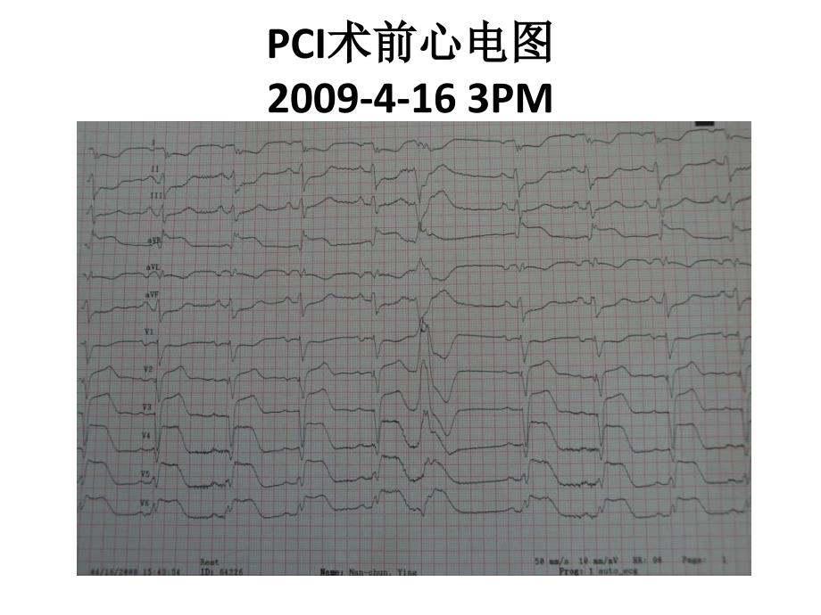 LAD及LCX同时闭塞致STEMI直接PCI治疗一例报告-赵迎.ppt_第3页