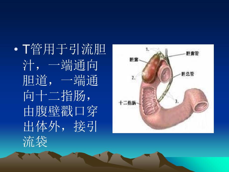 T型引流管的护理演示教学_第4页