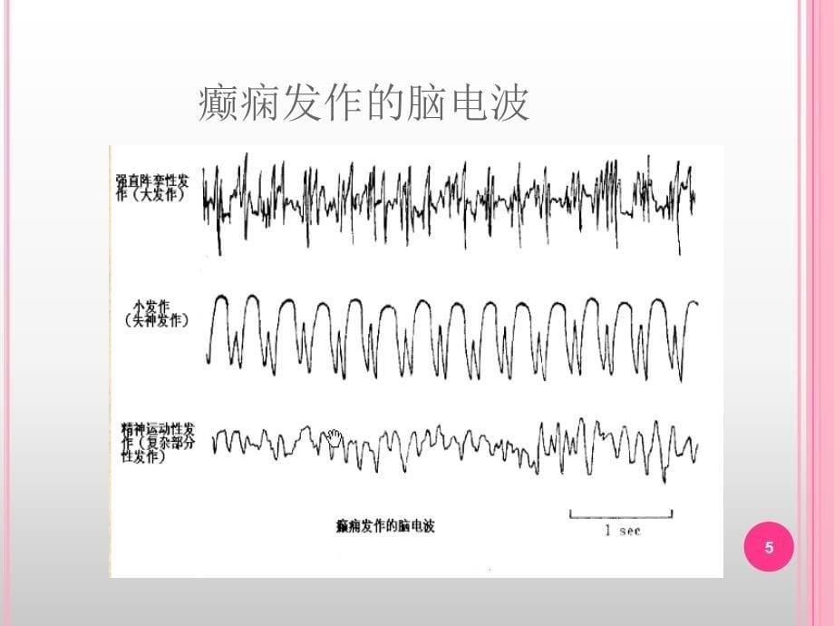 癫痫患者麻醉用量PPT幻灯片.ppt_第5页