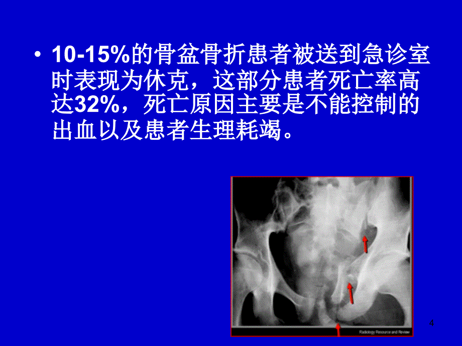 （推荐精选）骨盆骨折的处理指南.ppt_第4页