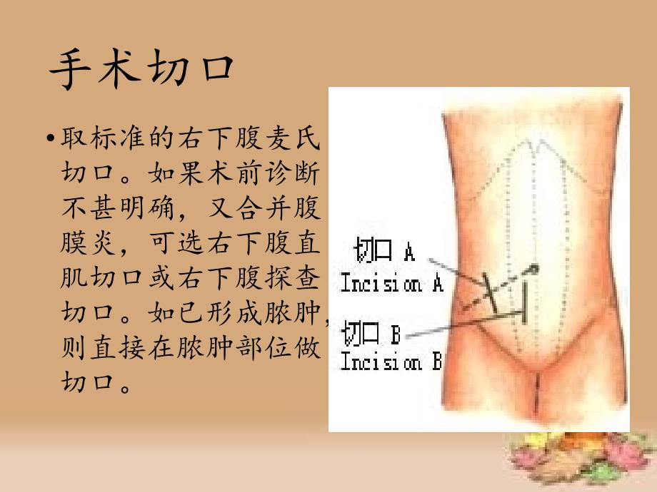 阑尾切除术的手术配合PPT幻灯片.ppt_第4页