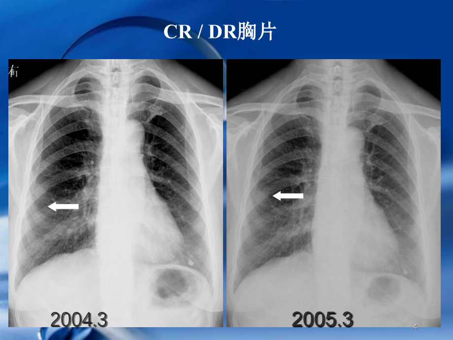 肺磨玻璃结节CT诊断PPT幻灯片.ppt_第4页