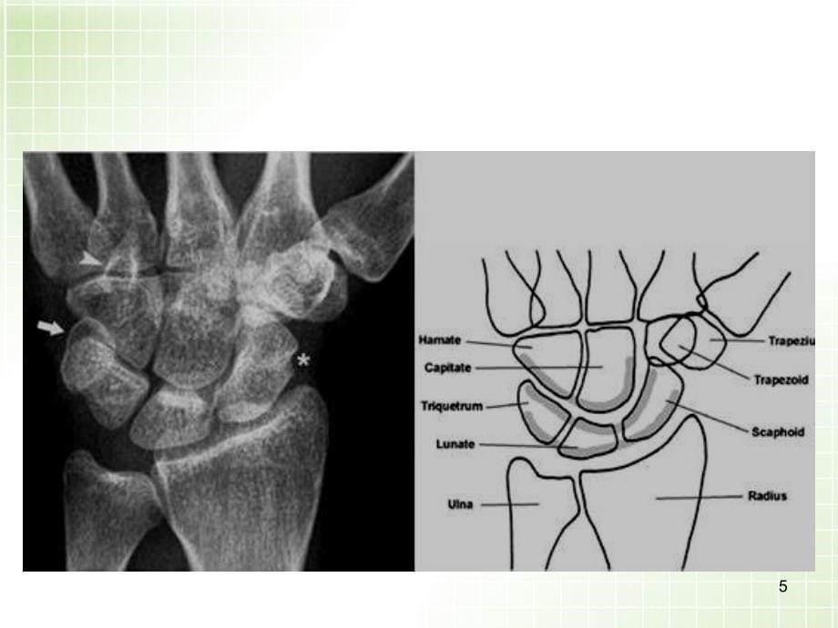 （推荐精选）腕关节X线解剖及常见骨折诊断.ppt_第5页
