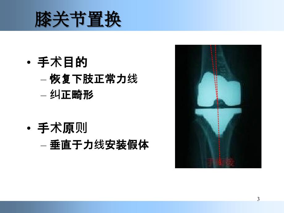 （推荐精选）膝关节置换标准技术.ppt_第3页