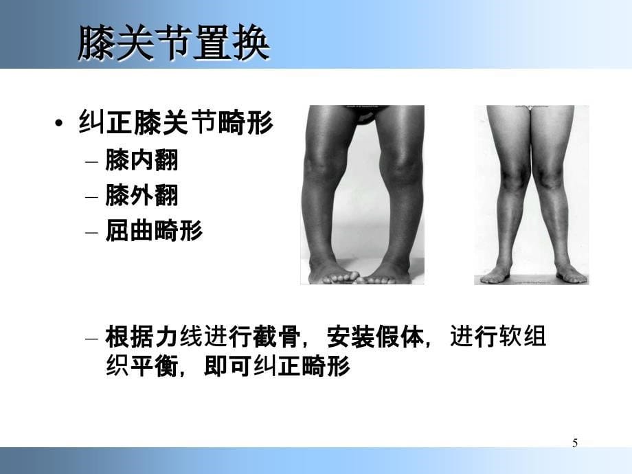 （推荐精选）膝关节置换标准技术.ppt_第5页