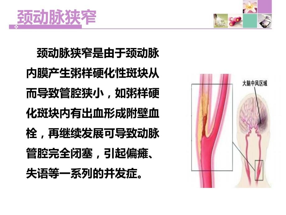 颈动脉内膜剥脱术PPT幻灯片.ppt_第4页