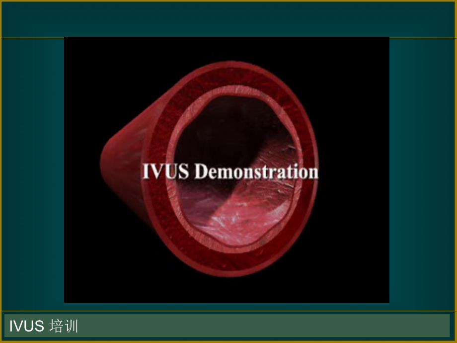 IVUS-血管内超声基础和临床教案资料_第2页