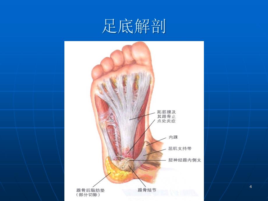 跟痛症PPT幻灯片.ppt_第4页