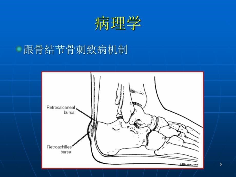 跟痛症PPT幻灯片.ppt_第5页