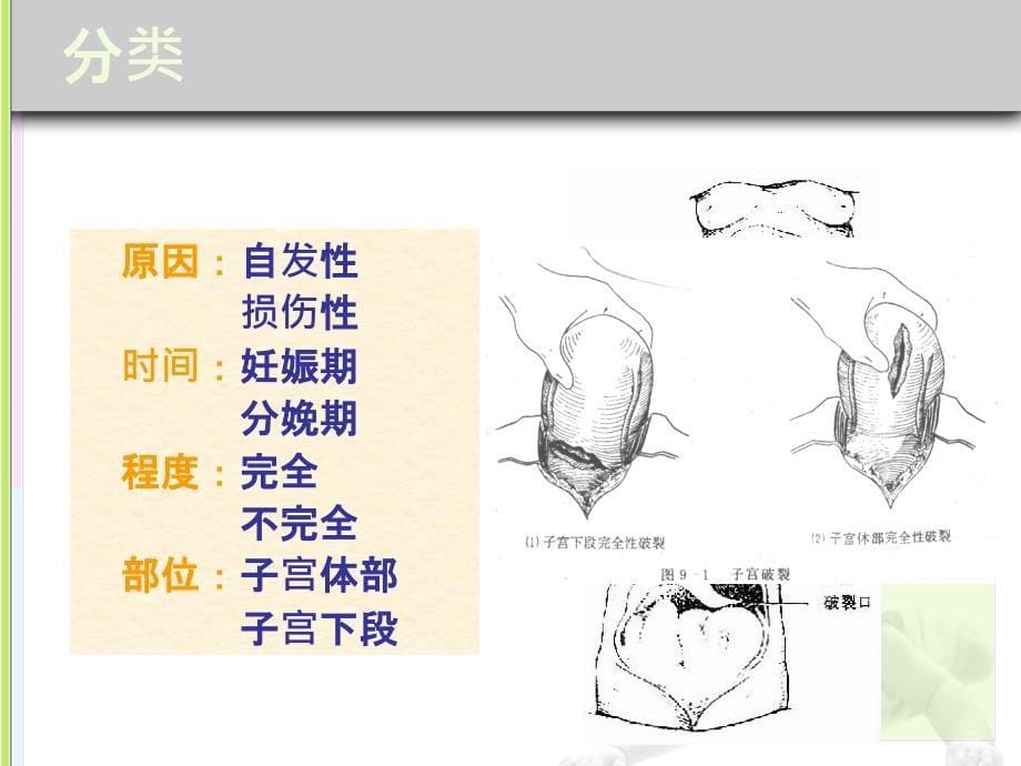 妇产科学 子宫破裂ppt课件_第5页