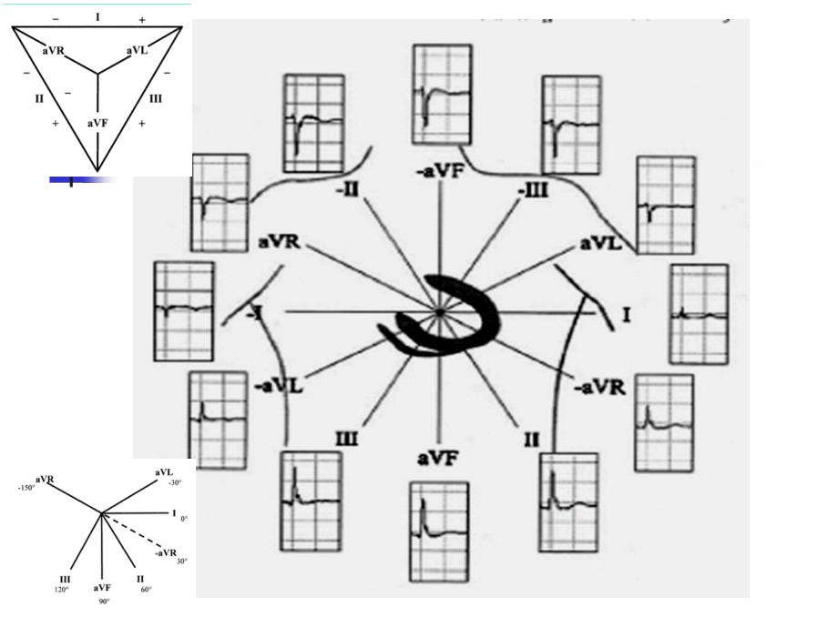 心电图aVR导联新价值ppt课件_第2页