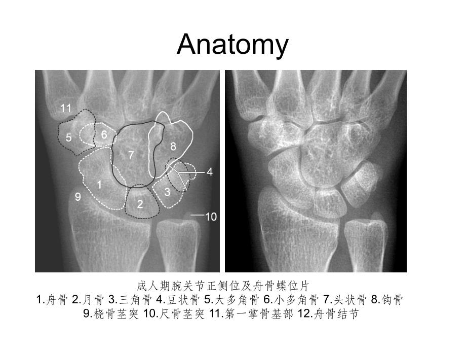 腕关节-X线解剖ppt课件_第3页