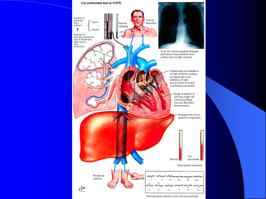 内科学课件-慢性肺原性心脏病_第3页